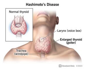 Hashimoto's Disease